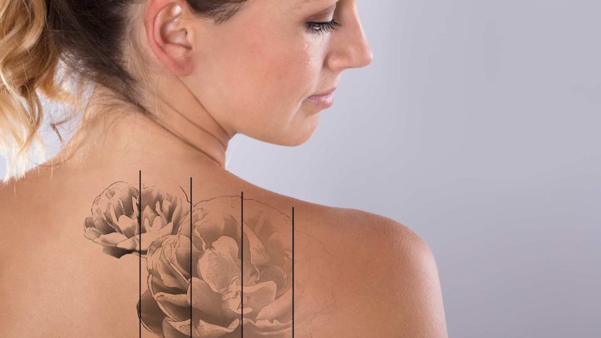 Tattoo Removal Technology